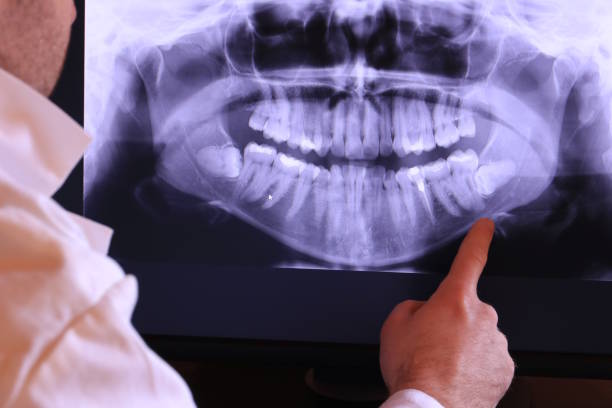 Best Emergency Dental Extractions in Lemont, IL